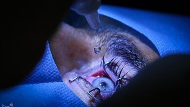 عمل تغییر رنگ چشم عوارض خطرناکی دارد