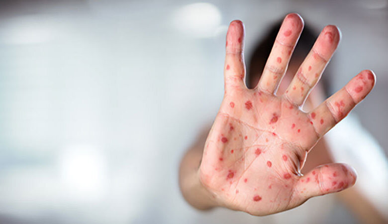 فرد مبتلا به سرخک 14 نفر را مبتلا می کند/ پوشش واکسیناسیون در کشورهای همسایه مناسب نیست