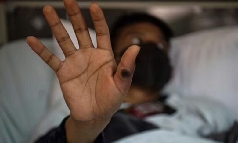 ضرورت آمادگی کامل در مقابله با آبله میمون - خبرگزاری مهر ایران و جهان