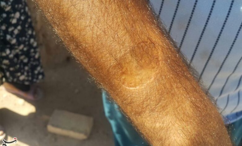 بروز 8752 مورد ابتلا به سالک/ شهرهای آلوده به &quot;لیشمانیوز&quot;