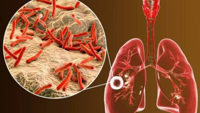 "سل" کشندهترین بیماری عفونی جهان شد