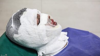 با رعایت این نکات از سوختگی پیشگیری کنید