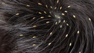 راه های پیشگیری، علائم و درمان شپش سر