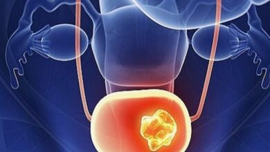 سیگار عامل ابتلا به سرطان مثانه/جوشکاران و تراشکاران در خطر