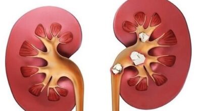 علائم سنگ کلیه در کودکان چیست؟