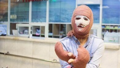 وقوع سالانه 300000 مورد سوختگی در کشور/ درجات مختلف سوختگی