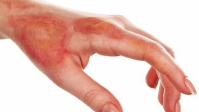 چه کسانی در معرض خطر سوختگی هستند؟ /نیاز کشور به &quot;بانک پوست&quot;