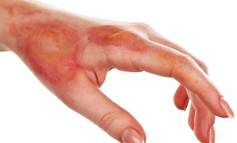 چه کسانی در معرض خطر سوختگی هستند؟ /نیاز کشور به &quot;بانک پوست&quot;