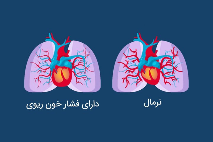 کنترل فشار خون با توصیه های طب ایرانی