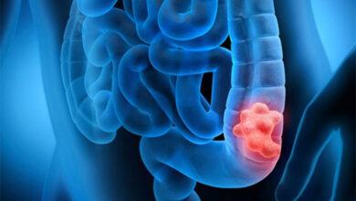 این غذاها از سرطان روده بزرگ پیشگیری می کنند