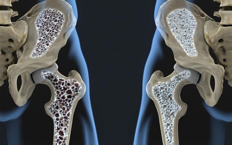 بهترین ویتامین ها برای تقویت استخوان