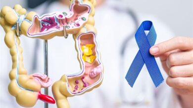 علائم ابتلا به سرطان روده بزرگ/سن مناسب انجام کولونوسکوپی