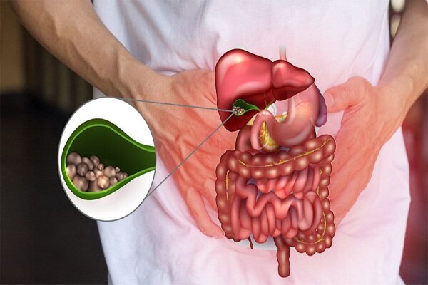 همه چیز در مورد سنگ های صفراوی ؛ چه زمانی به جراحی نیاز داریم؟
