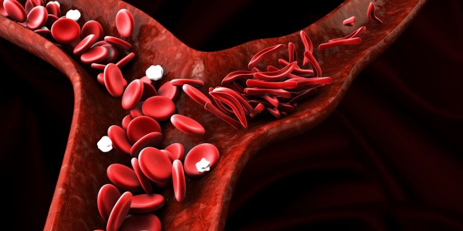 علائم کم خونی داسی چیست و چگونه درمان می شود؟