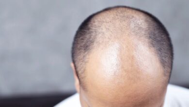 کمبود این ویتامین باعث ریزش مو می شود