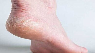 ترک خوردگی پاشنه به دلیل کمبود این 2 ویتامین ایجاد می شود