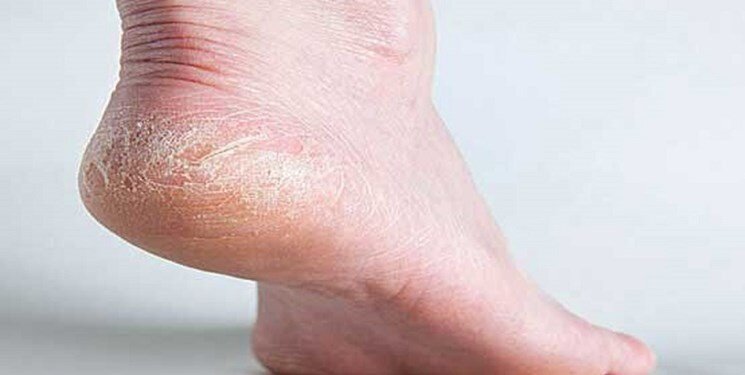 ترک خوردگی پاشنه به دلیل کمبود این 2 ویتامین ایجاد می شود