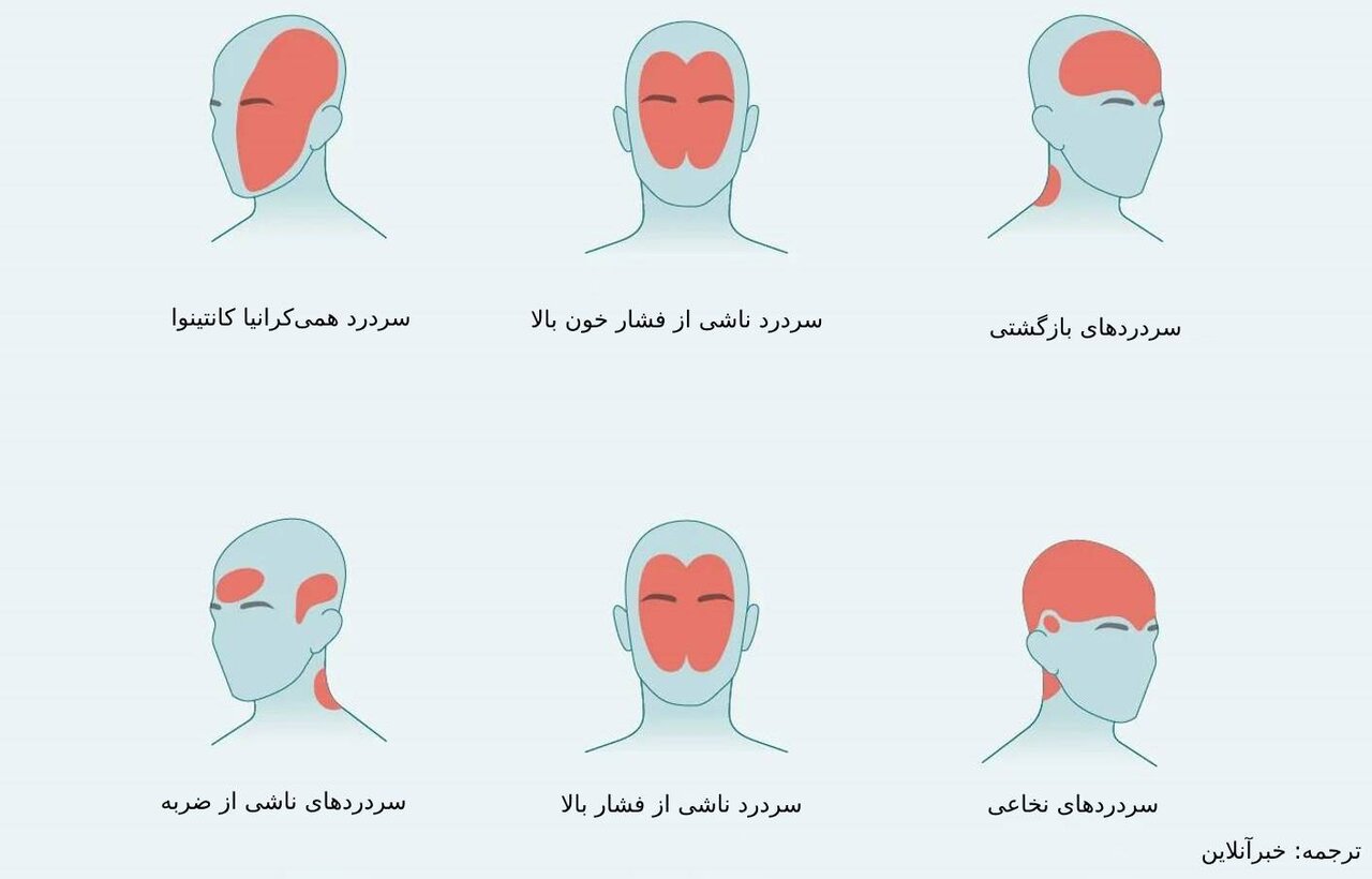 درد در مناطق مختلف سر چیست؟
