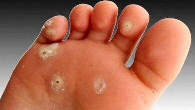 ذرت چگونه درمان می شود؟