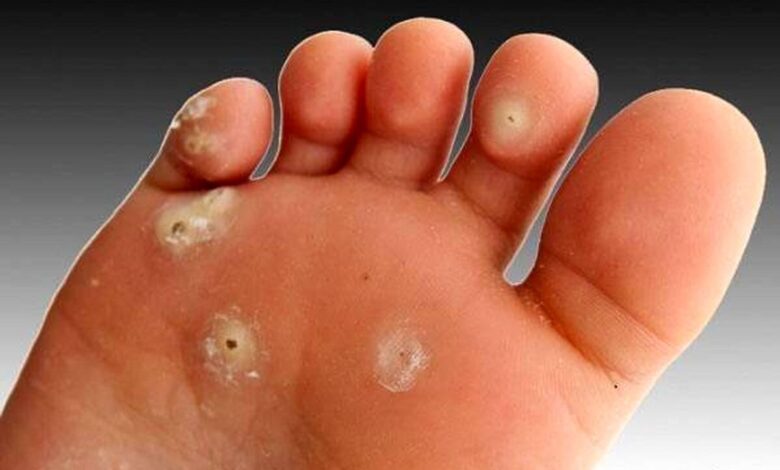 ذرت چگونه درمان می شود؟