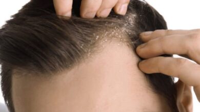 آیا شما شوره سر دارید؟ شاید دلیل کمبود این ویتامین باشد