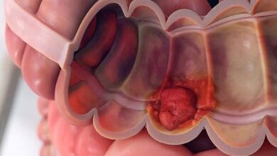 سرطان روده بزرگ ؛ بیماری خاموش که با تشخیص زودهنگام قابل کنترل است - آژانس خبری مهر | اخبار ایرانی و جهانی