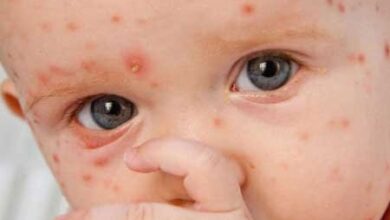 گزارش یک بیماری مسری در ایران؛ سرخک دوباره برگشت!