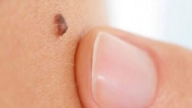 نشانه مهم سرطان را بدانید