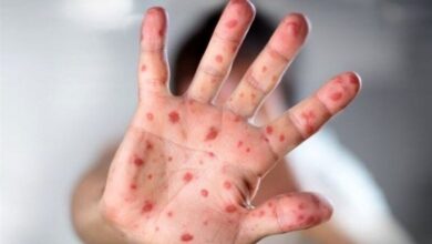 مشاهده سرخک در این استان/ 1 گزارش های مثبت قطعی گزارش شده است