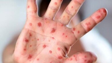 شیوع بیماری مسری در کشور ؛ اگر واکسینه نکنید ، تا 5 ٪ منتقل می شود