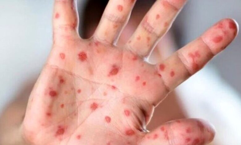 شیوع بیماری مسری در کشور ؛ اگر واکسینه نکنید ، تا 5 ٪ منتقل می شود