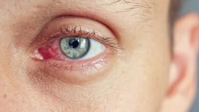 آلرژی چشم ؛ از تأثیر آلرژن ها تا علائم