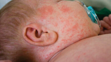 سرخک از کدام کشور وارد ایران شد؟ / سرخک بسیار مسری هستند