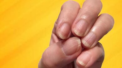 خطوط عمودی یا افقی روی ناخن ها چیست؟