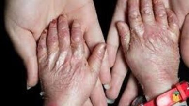 خبر خوب برای بیماران پروانه