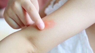 استراتژی های پیشگیری و درمانی برای نیش های آزار دهنده - آژانس خبری مهر | اخبار ایرانی و جهانی