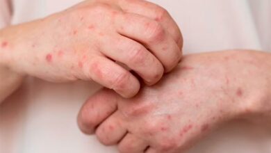 افزایش شیوع آبله مرغان در فصل بهار/علائم بیماری چیست؟