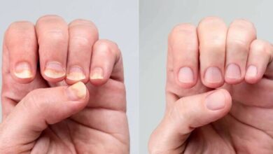 نشانه تغییر رنگ ناخن چیست؟