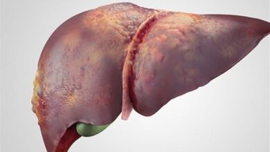 عوامل خطر ابتلا به سرطان کبد/پیشنهاد سونوگرافی به برخی افراد