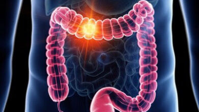 هشدار خطر ابتلا به سرطان روده بزرگ در جوانان