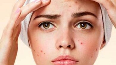 پنج ماده ای که به مبارزه با آکنه کمک می کنند