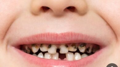 پوسیدگی دندان به دلیل کمبود این ویتامین ها