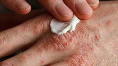 تغییر فصل ، تحریک کننده اگزما نه ایجاد آن - آژانس خبری مهر | اخبار ایرانی و جهانی