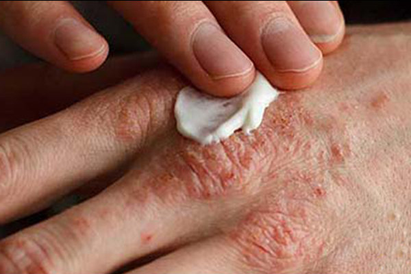 تغییر فصل ، تحریک کننده اگزما نه ایجاد آن - آژانس خبری مهر | اخبار ایرانی و جهانی