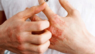 علت مهم اگزما در پوست