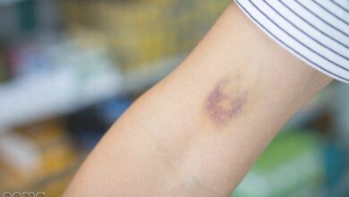 کبودی بدن کمبود این ویتامین است