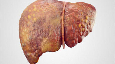 پیش بینی بیماری کبد چرب - آژانس خبری مهر | اخبار ایرانی و جهانی