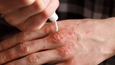 واقعیت پزشکی در مورد بیماری مزمن پسوریازیس