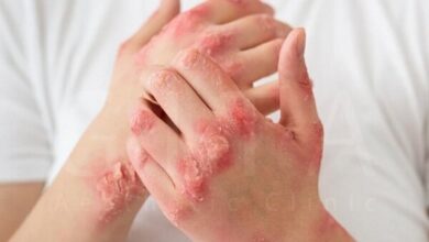 بیماری پسوریازیس چیست؟ - اخبار آنلاین