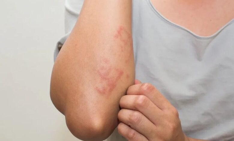 بیماری سلیاک چیست و علائم چیست؟
